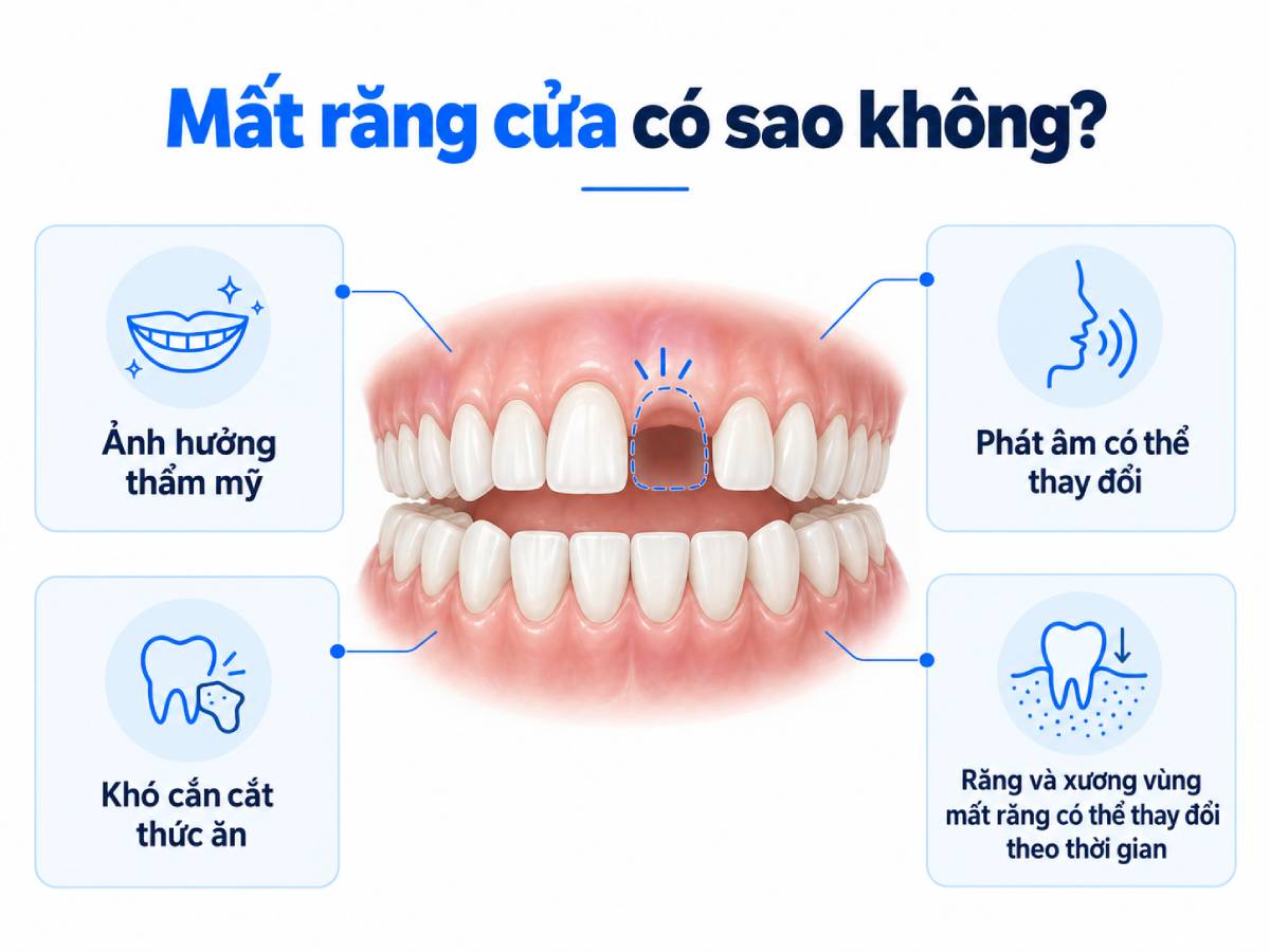 Mất răng cửa có thể ảnh hưởng đến thẩm mỹ, phát âm, khả năng cắn thức ăn và sự ổn định của răng – xương quanh khoảng mất răng.